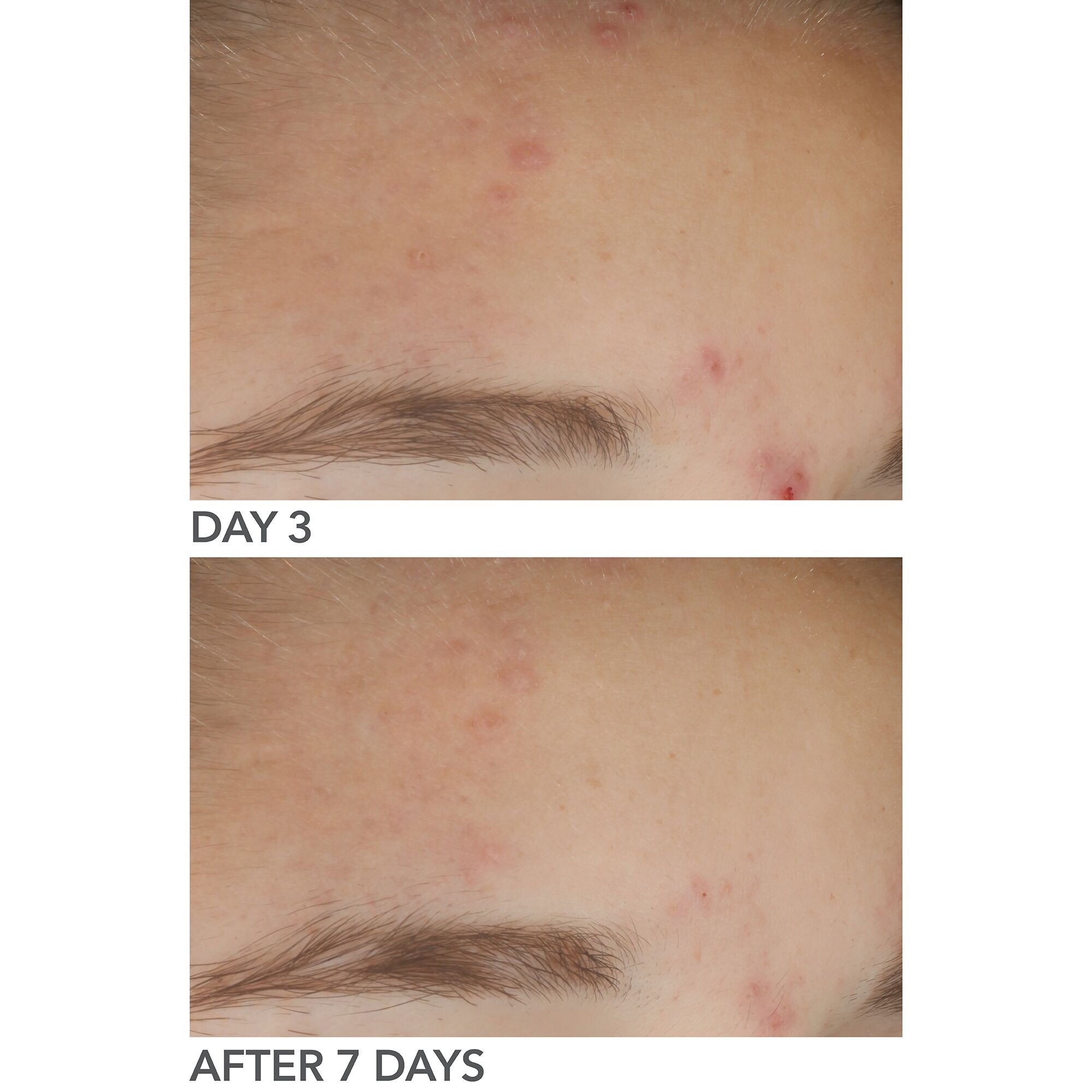 Dr Dennis Gross Alpha Beta On The Spot Gel 30ml 20 Dr Dennis Gross Alpha Beta On The Spot Gel 30ml